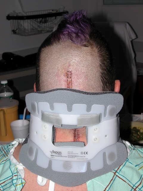 Back of head in brace